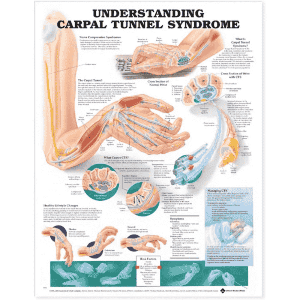 UNDERSTANDING CARPAL TUNNEL (LAMINATED)