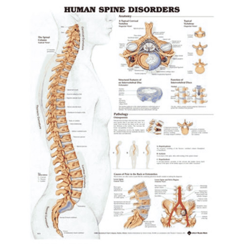 HUMAN SPINE DISORDERS CHART (LAMINATED)