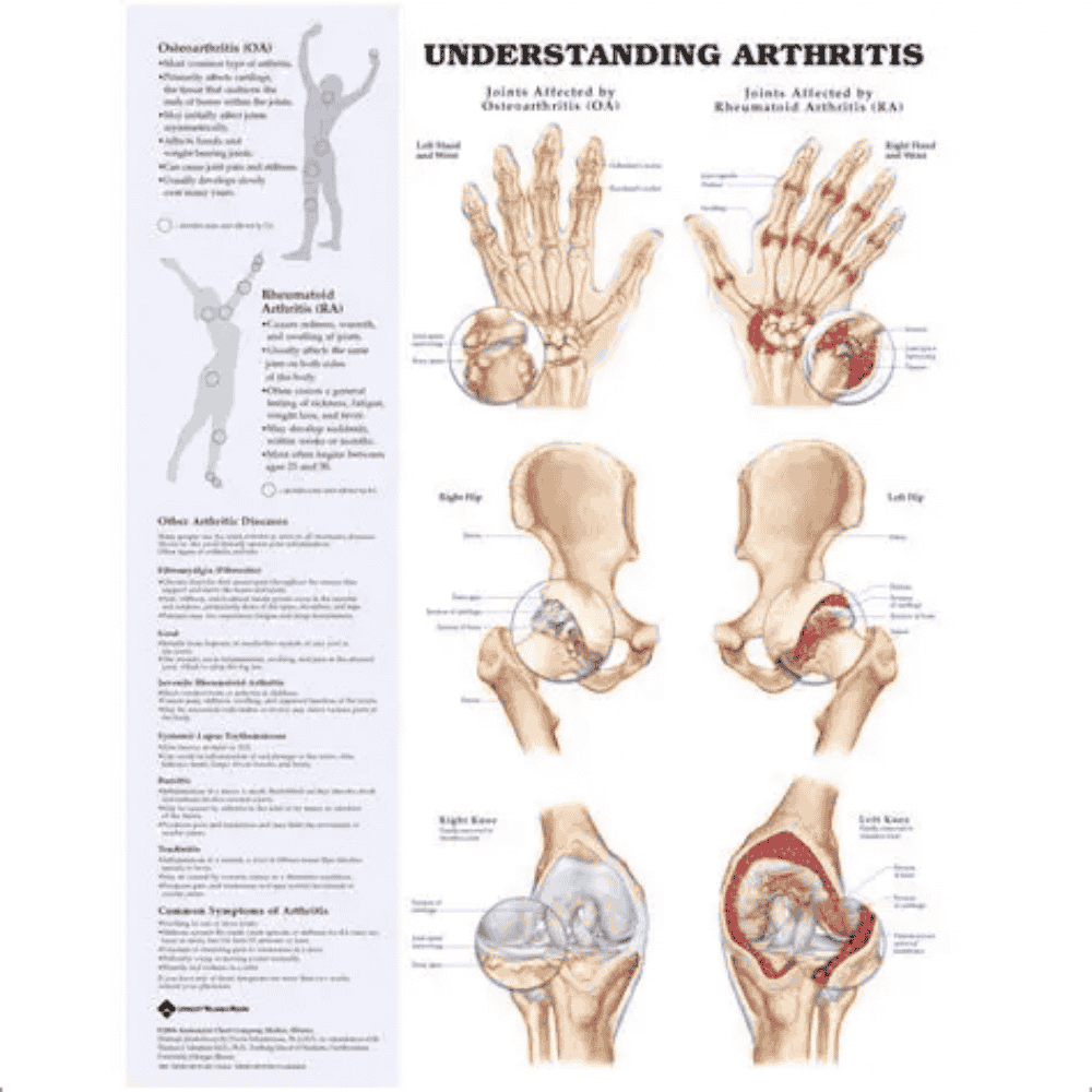 UNDERSTANDING ARTHRITIS CHART (LAMINATED)