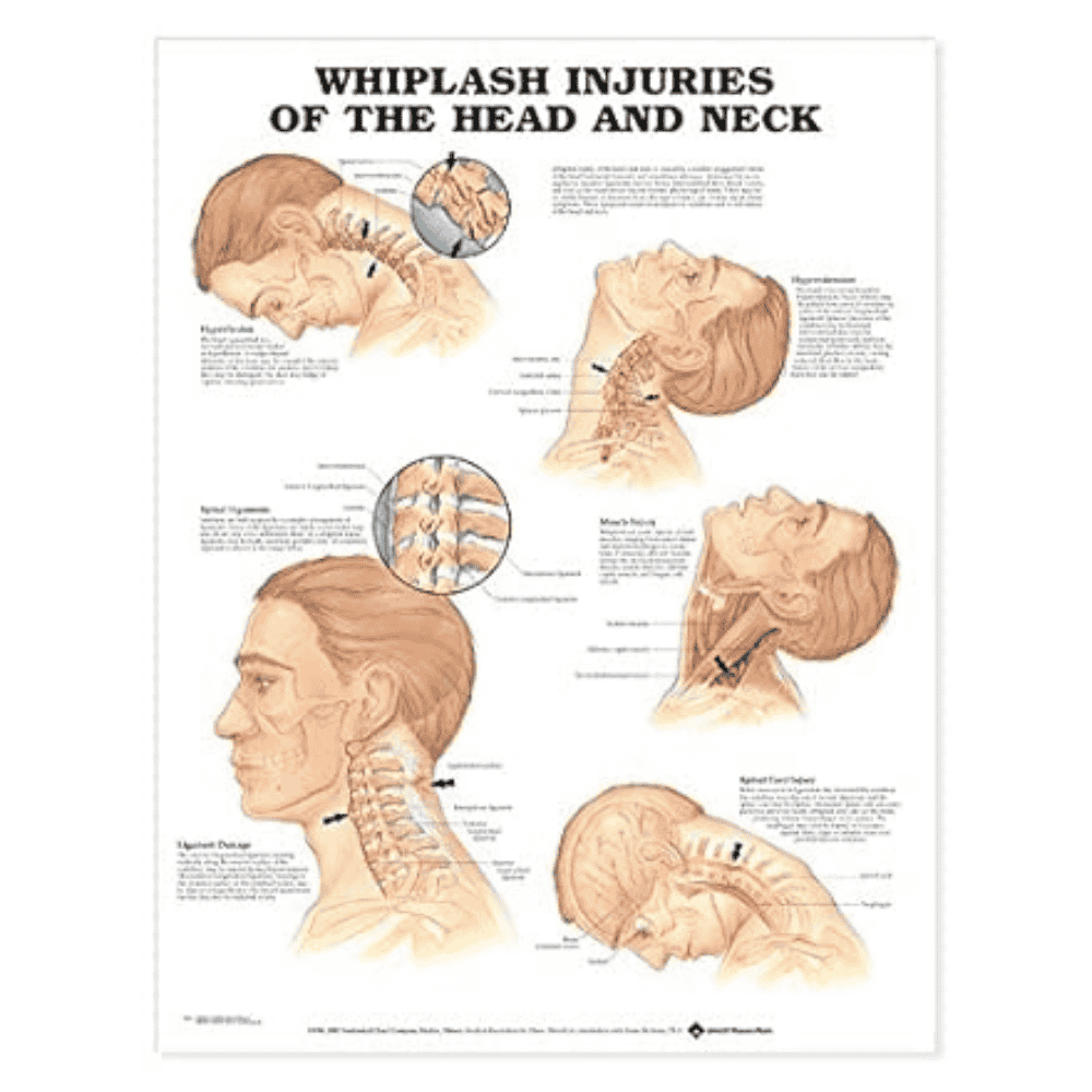WHIPLASH INJURIES CHART (LAMINATED)
