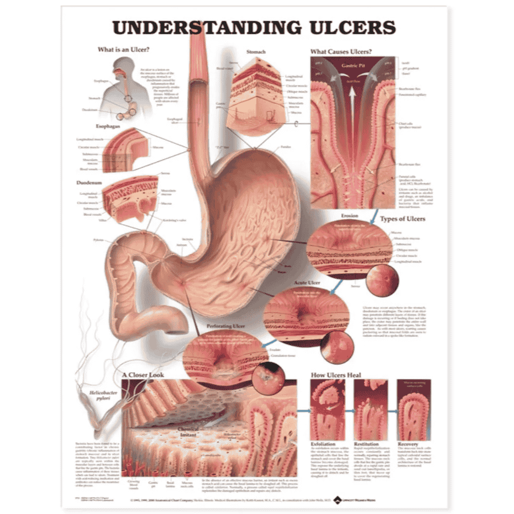UNDERSTANDING ULCERS ANATOMICAL CHART (LAMINATED)